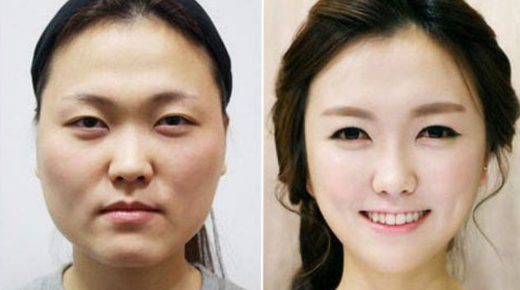 Exploring Korean Plastic Surgery - Before and After